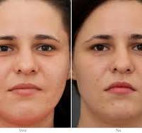 huidverzorging vette huid