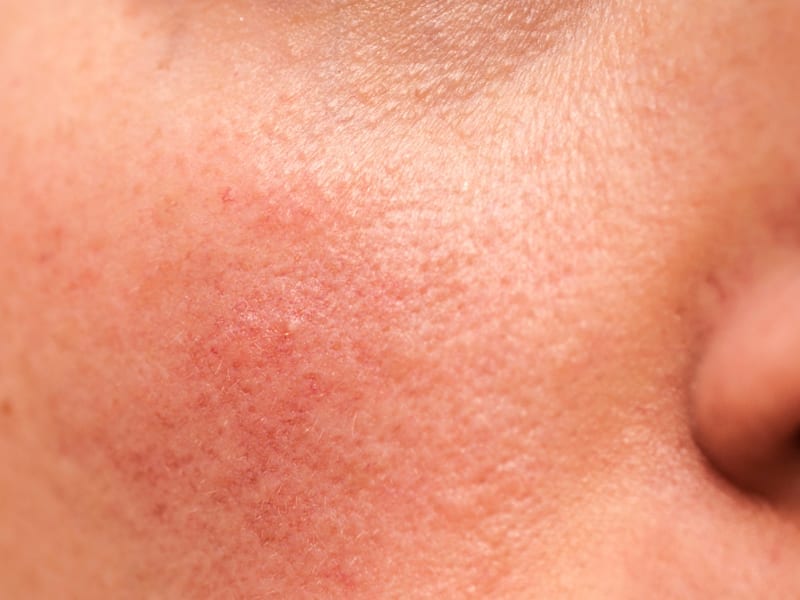 gezichtsverzorging rosacea