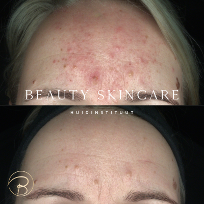 rosacea gezichtsverzorging