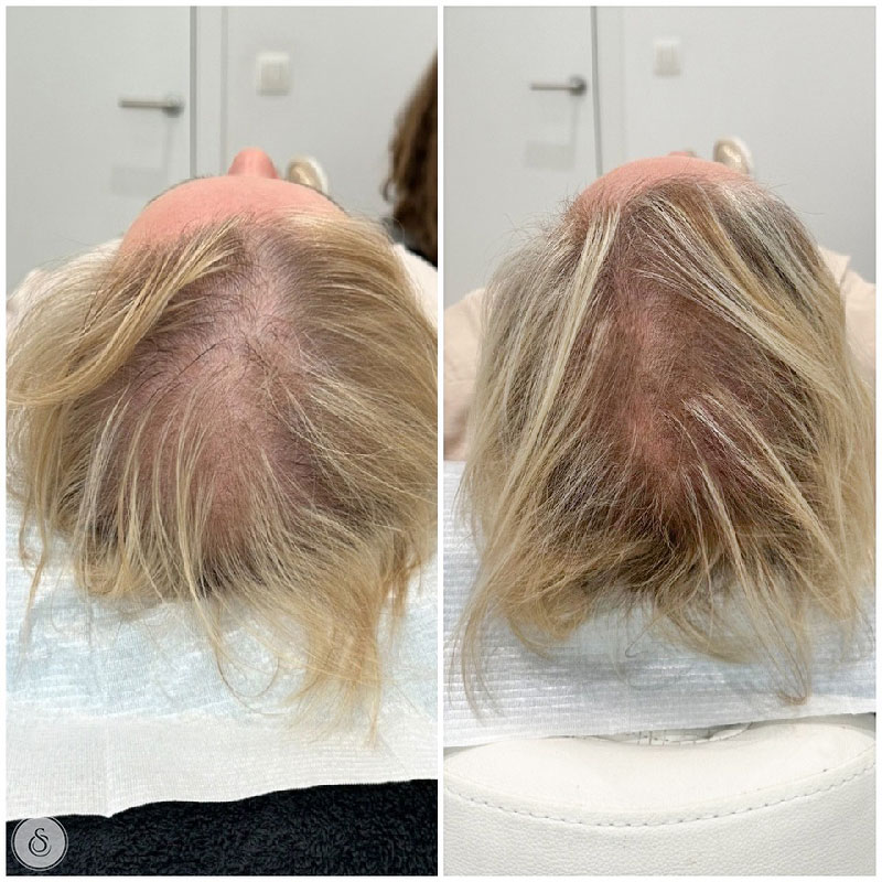 haarverzorging dun haar